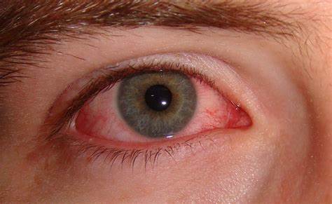 फैलिंदै आँखा पाक्ने रोग : कोशीमा रोकथामको लागि पहल शुन्य